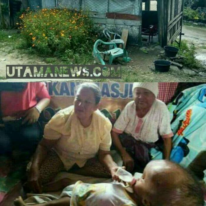 Indah, Balita Penderita Hydrocepalus Butuhkan Uluran Tangan
