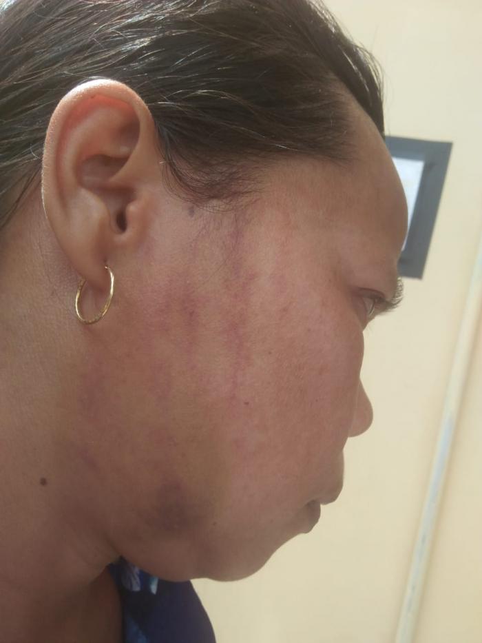 Wajah korban bergores memar dan bengkak akibat dipukuli oleh suami sahnya sendiri.&nbsp;