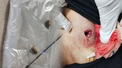 Luka tembak di tubuh anak Sergai