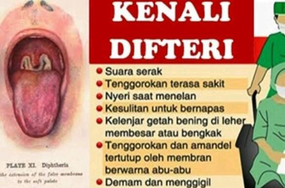 Pemkab Deli Serdang Tingkatkan Kewaspadaan Penyakit Difteri